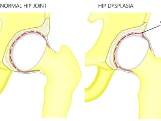 Hip Dysplasia Thumbnail