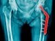 Hip replacement Thumbnail