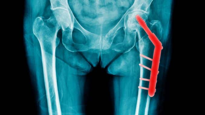 Hip replacement Thumbnail