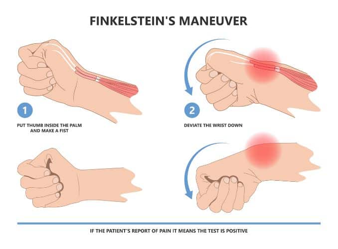 What is The Finkelstein Test?- De Quervain's tenosynovitis