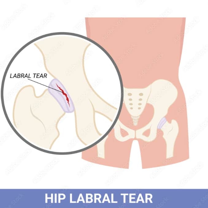 What is a Hip Labral Tear