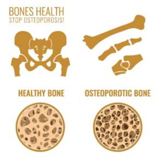 the osteopenia - Osteoporosis Wrist Exercises