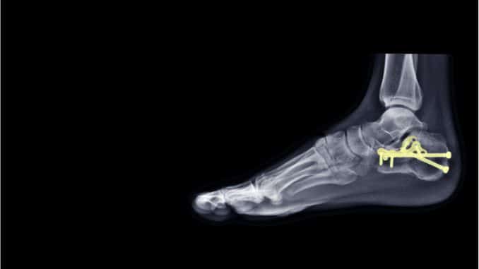 Ankle x-ray radiograph - Calcaneal Stress Fracture