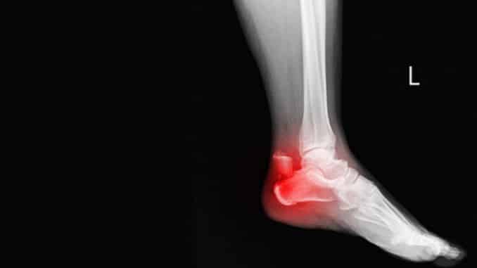 Film ankle X-ray radiograph