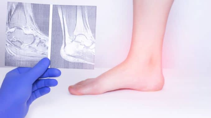 Occurence of osteoarthritis in ankle