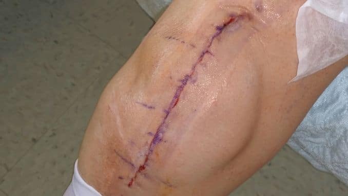 What is Knee Replacement Surgery
