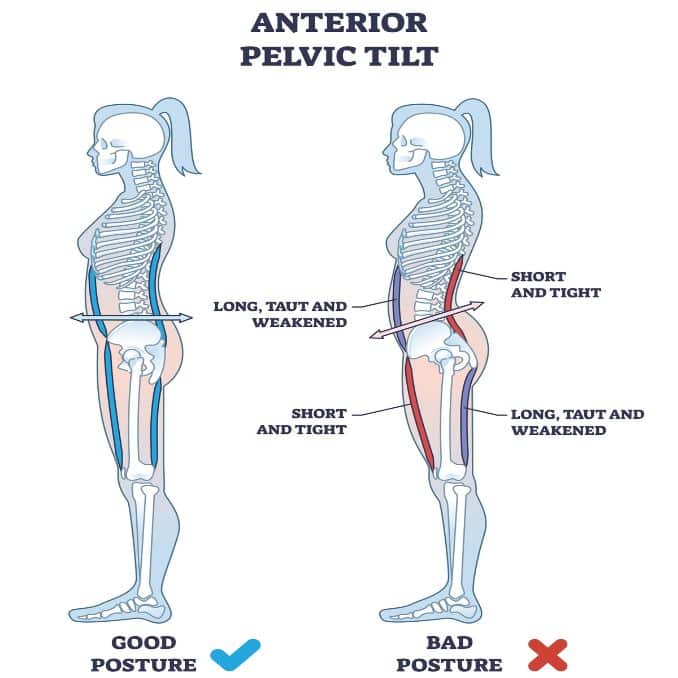 anterior pelvic tilt - Posture Correction Exercises
