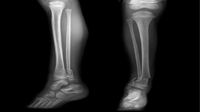 tibia and fabula x-ray - Ankle Osteoarthritis