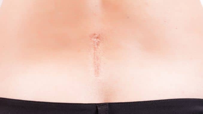 Scar on the Female Back after the Spine Surgery