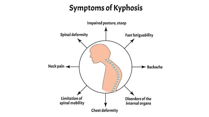 Symptoms-Kyphosis Exercises