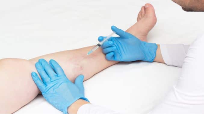 doctor perform sclerotherapy