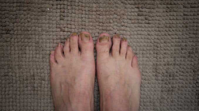 onychomycosis-with-fungal-nail-infection - Why Did My Toenail Fall Off Without Pain