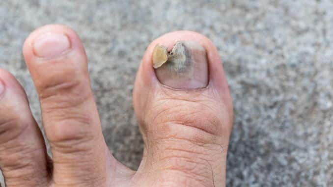 toenail-fungus