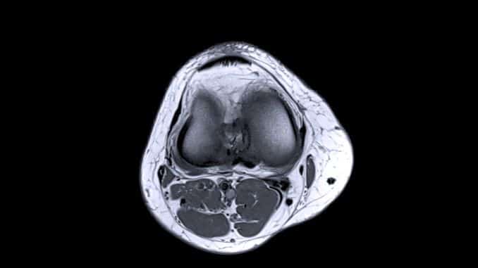 Anterior Cruciate Ligament